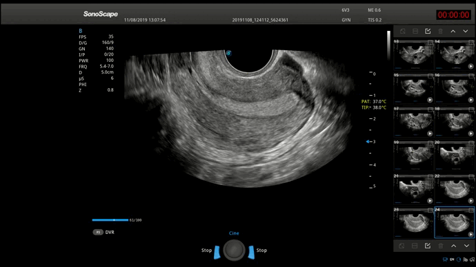 S-endometrio