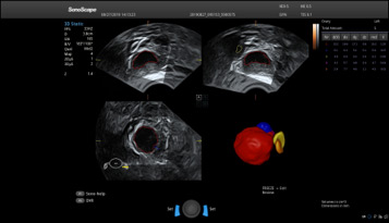 Ginecologia, AVC Follicle