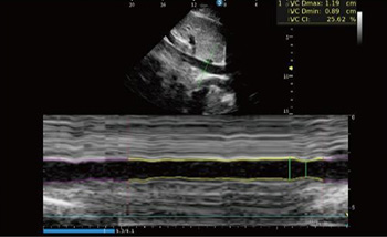SonoScape S-IVC